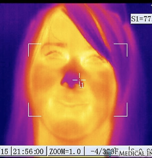 Facial skin temperatures